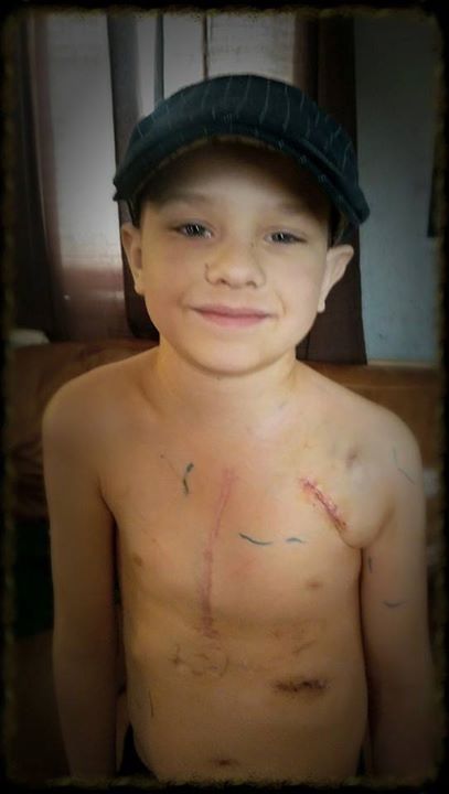 對任何人來說這絕非易事，何況卡特才7歲而已。但更讓卡特沮喪的，是當他看見自己術後的滿身傷疤。