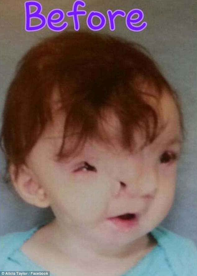 Violet was born with frontonasal dysplasia, a congenital malformation that widened her facial features, specifically her nose and the space between her eyes