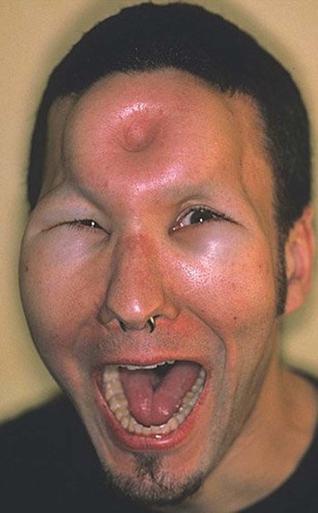 Unlike many extreme body modification procedures, the bagel head procedure is temporary and carries little risk.