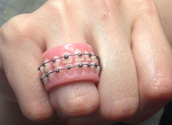 A ring made of dentures WITH BRACES.