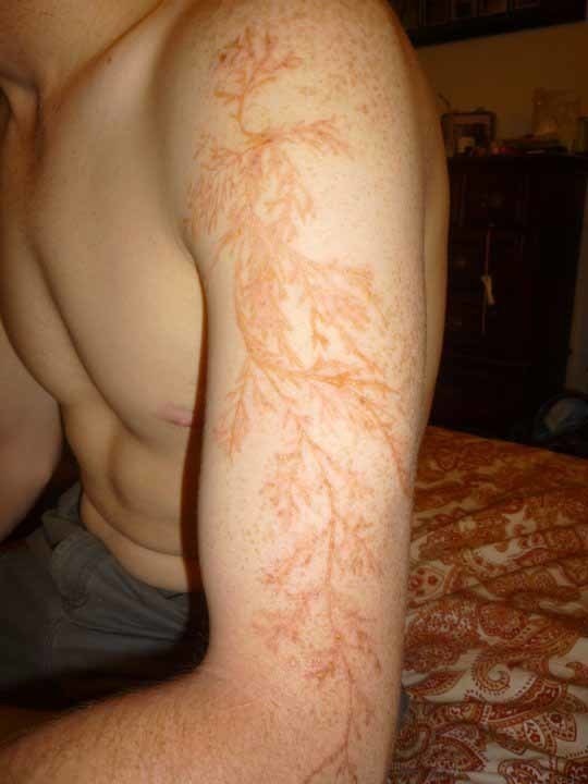 A man's arm after being stuck by lightning.
