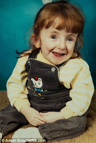 Mrs Dinsdale, pictured as a child, was diagnosed with osteogenesis imperfecta when she was just five days old, and doctors discovered all her bones had broken in the womb or during childbirth