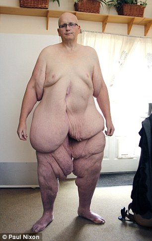 The former postman, from Ipswich, Suffolk, became thinner after getting gastric bypass surgery in 2010 but the NHS have refused to give him an operation to remove excess skin.
