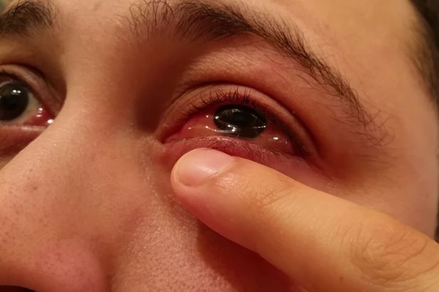 Man has blister on his eyeball