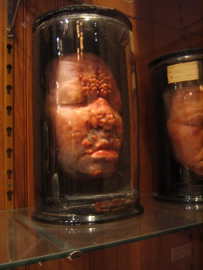 Aside from its actual medical specimens, the M&uuml;tter Museum is home to many wax models. They demonstrate the stages of different diseases. 