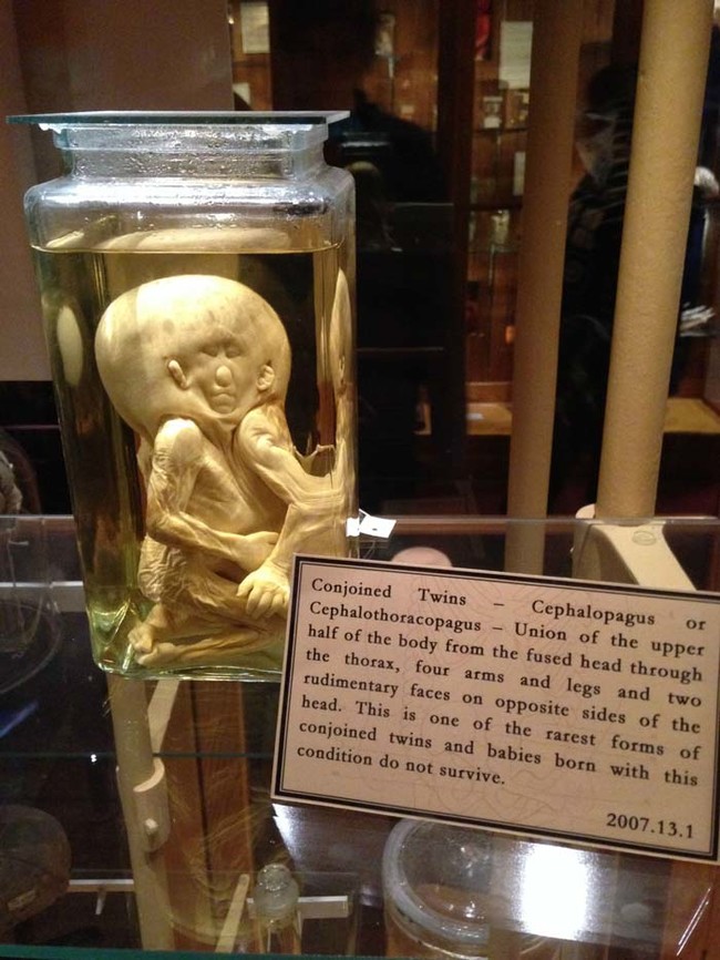 These conjoined twins are some of the M&uuml;tter Museum's creepiest residents.