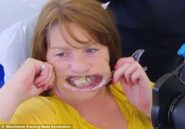 Angie Barlow, 48, was so terrified of going to the dentist she used superglue to stick her broken teeth back into her mouth when they fell out, which led to the erosion of the bone in her upper jaw