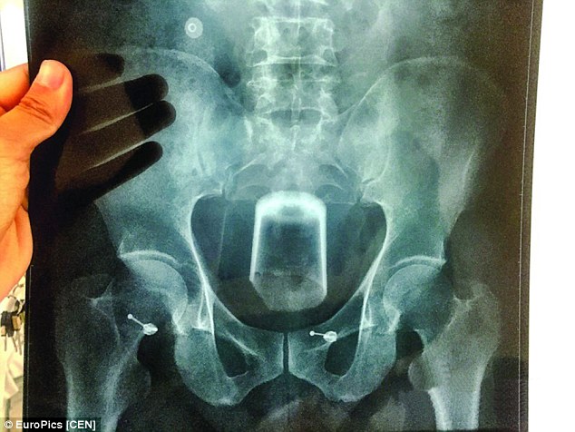 A Chinese man from Wuxi tries to treat his constipation by inserting a beer glass into his rear. An X-ray shows the container ends up getting stuck in his rectum