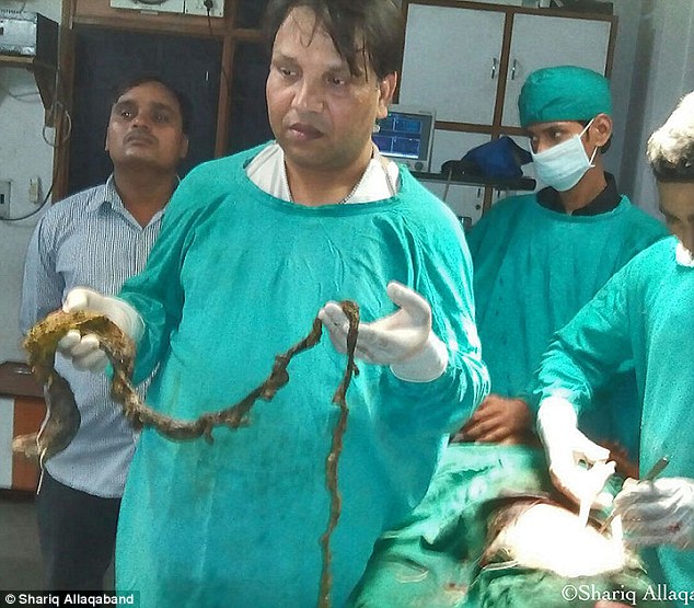 Dr Lal Bahadur Sidharth, a gastro and laproscopic surgeon who operated on Kavita, said: 'I didn’t expect the hairball to be this big. 'I had never seen such a case before'