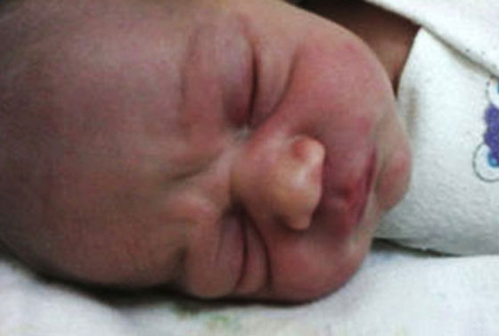 Baby+Abandoned+By+Parents+After+Suffering+Horrific+Burns+In+Incubator+Fire