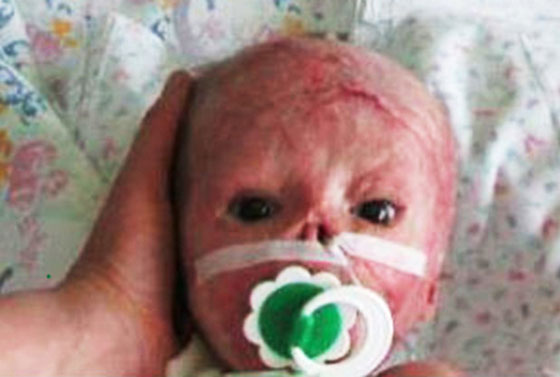 Baby+Abandoned+By+Parents+After+Suffering+Horrific+Burns+In+Incubator+Fire