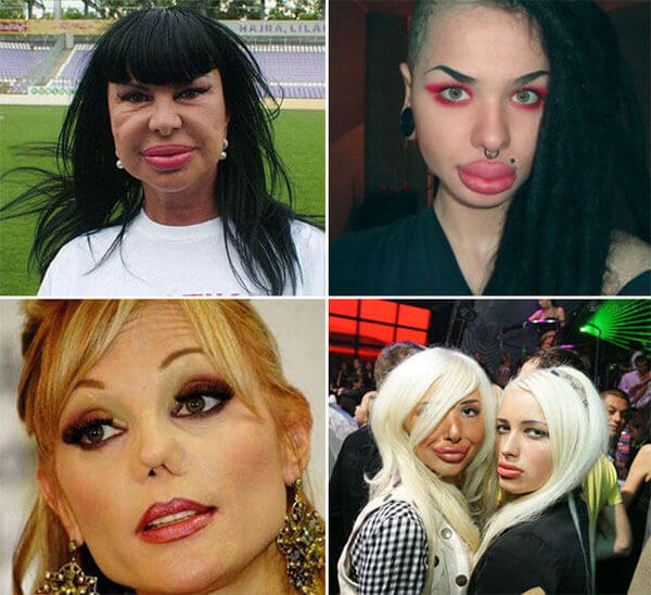 plastic surgery gone wrong 16