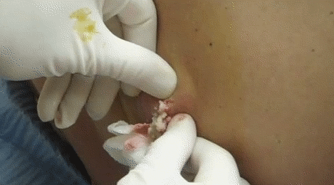 Can You Get Through These 17 GIFs Of Massive Zits Being Popped Without Shielding Your Eyes?