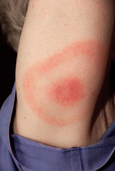 A rash like this will appear from an infected bite about 70-80% of the time, so it's a pretty good indicator.