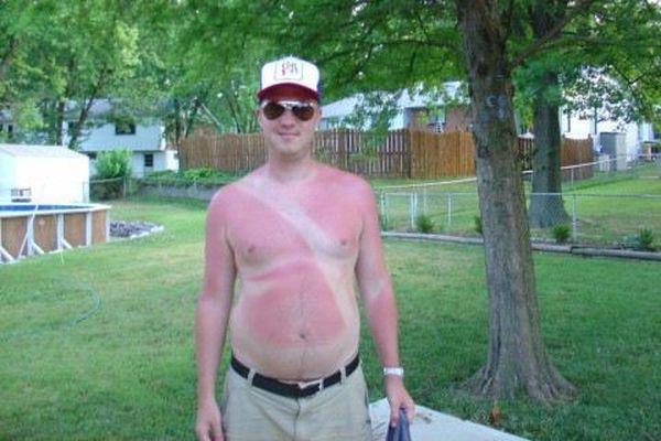 embarrassingly bad sunburns2088049383 mar 29 2015 1 600x400 A friendly (and painful) reminder to wear sunscreen this weekend! (28 Photos)