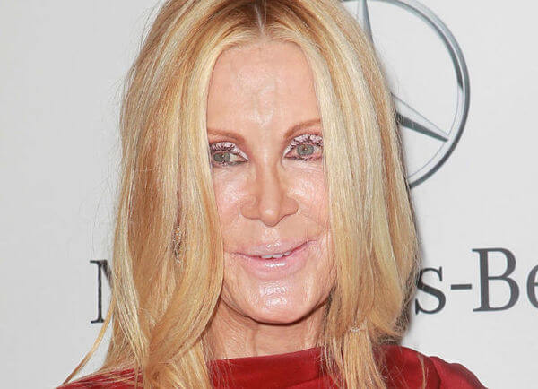 plastic surgery gone wrong 23