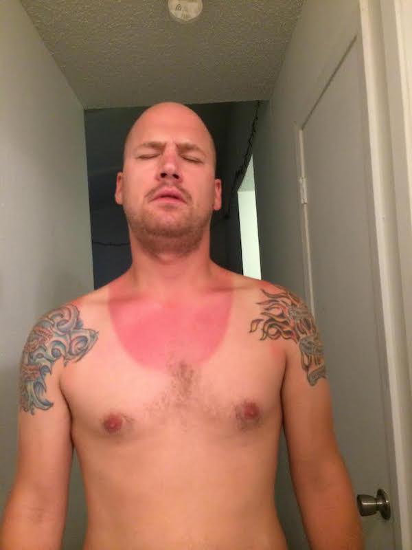 unnamed A friendly (and painful) reminder to wear sunscreen this weekend! (28 Photos)