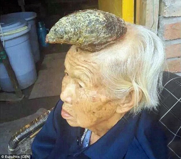 Liang Xiuzhen (above) from Sichuan, south west China, had a horn growing out of her head for two years