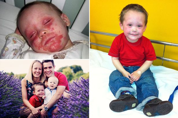 Morgan Bishop, aged 5, suffers such severe eczema he can barely walk and is in such pain. The family are at breaking point, having tried almost every treatment available on the NHS - including a form of chemotherapy