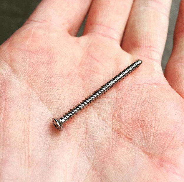 He went back to his orthopedic surgeon, who successfully removed the 1½-inch-long screw from his foot.