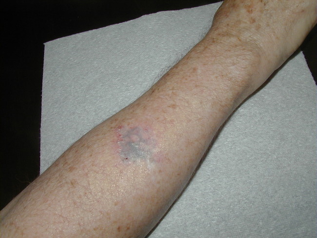 After a normal tattoo removal procedure, this is what a person's skin should look like.