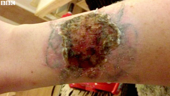 This is what Jess's arm looked like after using the kit.