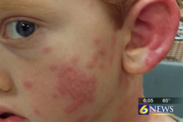 A 5-year-old boy from State College, PA picked one up and let it crawl all over his hand. Within minutes, he broke out in a red itchy rash.