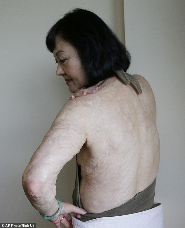In this Sept. 25, 2015 photo, Kim Phuc shows burn scars on her back and left arm at a hotel in Miami.  Tasks as simple as carrying her purse on her left side are too difficult.