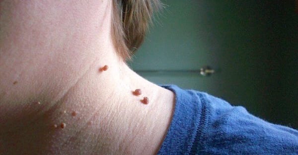 Many individuals, male or female, develop skin tags on the body at some point in their life. Skin tags are those pesky little flaps of skin that can form around the neck, armpit, or any place on the body where skin rubs or creases from friction.