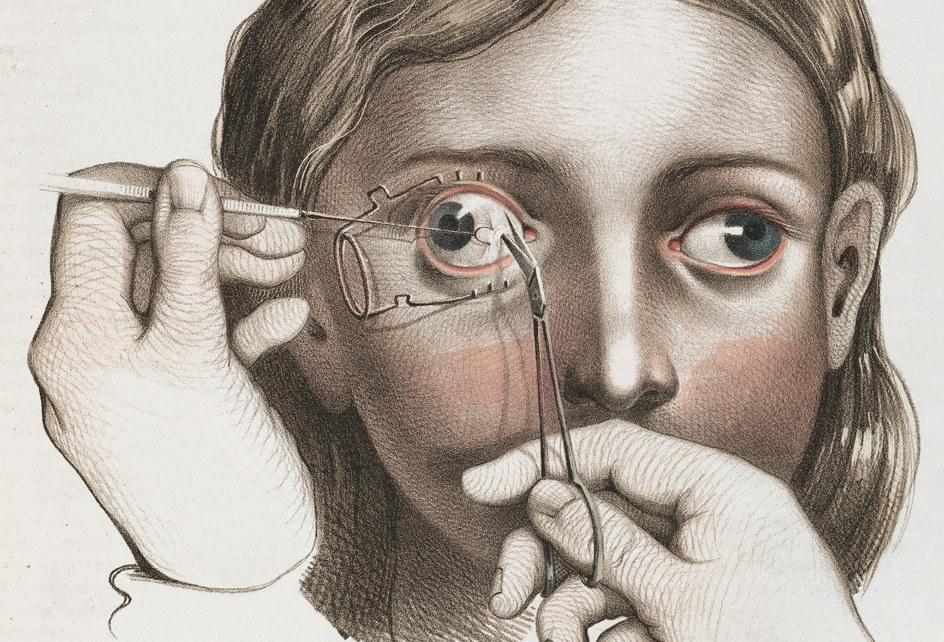 Surgery to correct strabismus (abnormal alignment of the eyes) which involved the division of the internal muscles of the eyeball so the eye would point in the right direction.