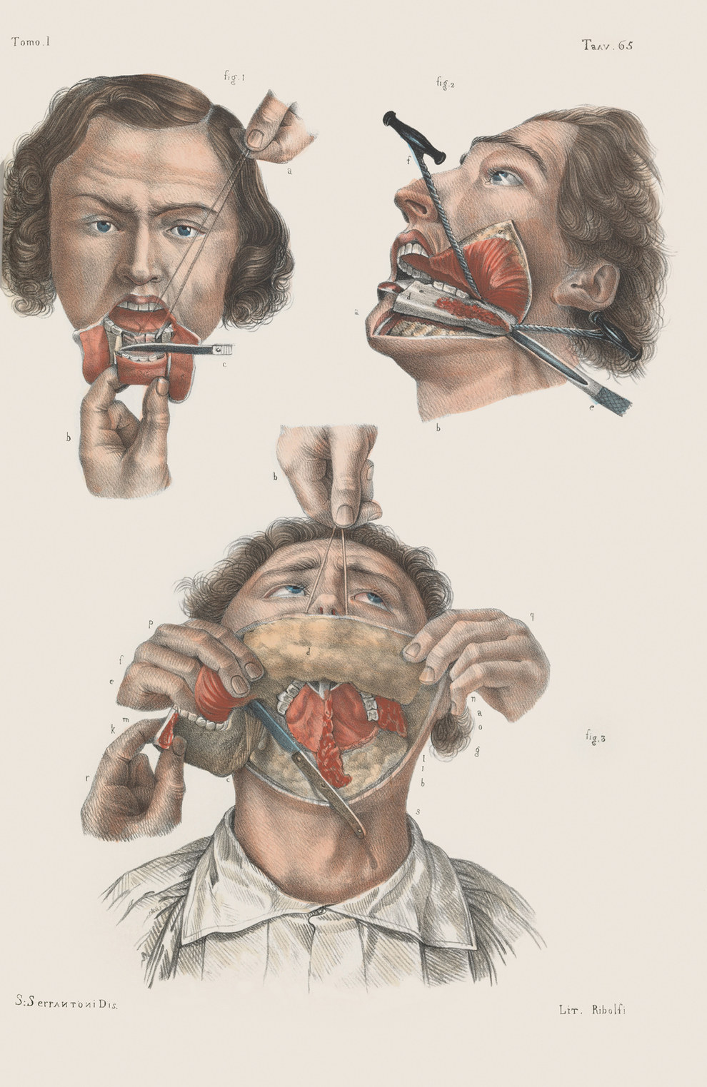 Removal (or "resection") of the lower jaw.