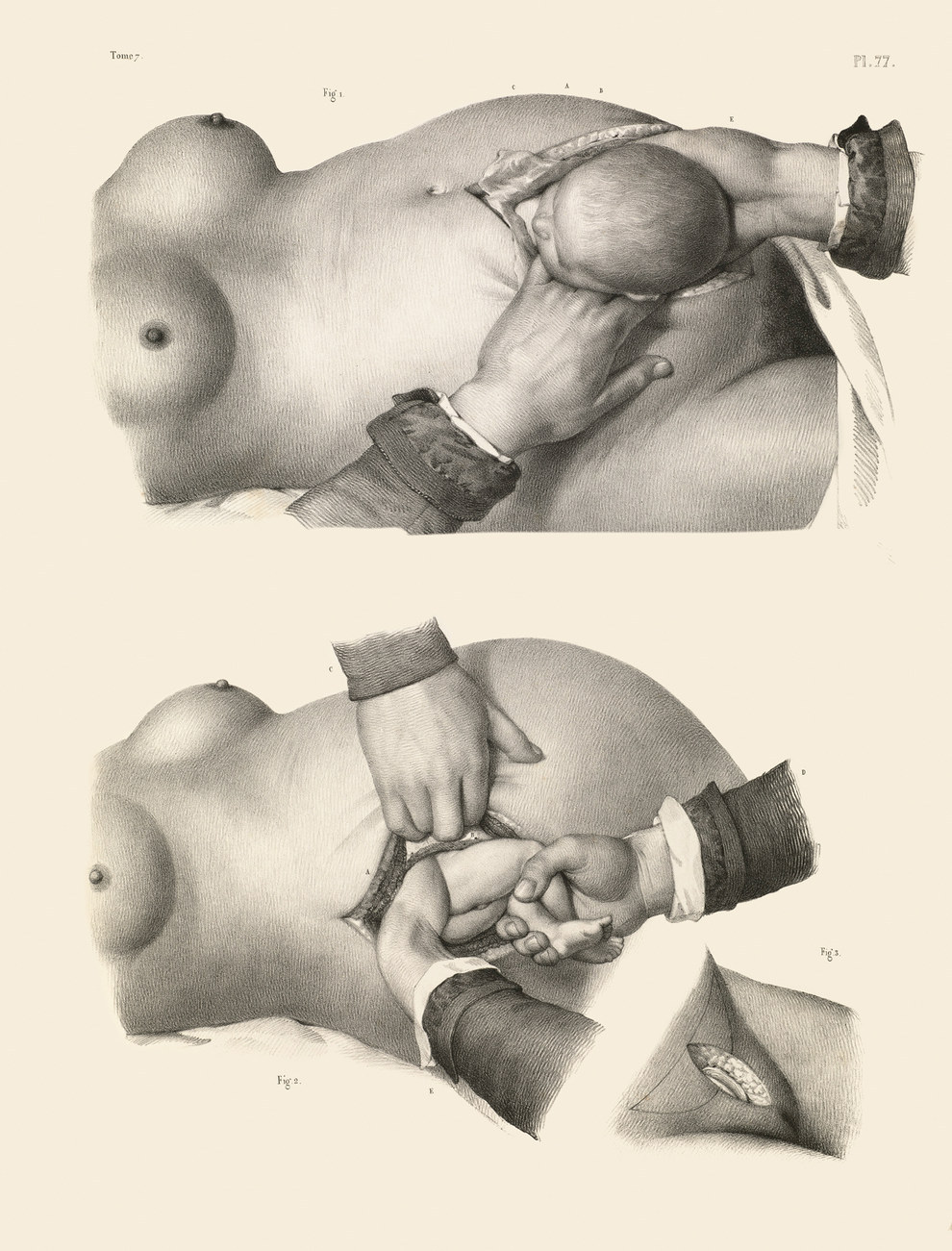Two kinds of caesarian section.