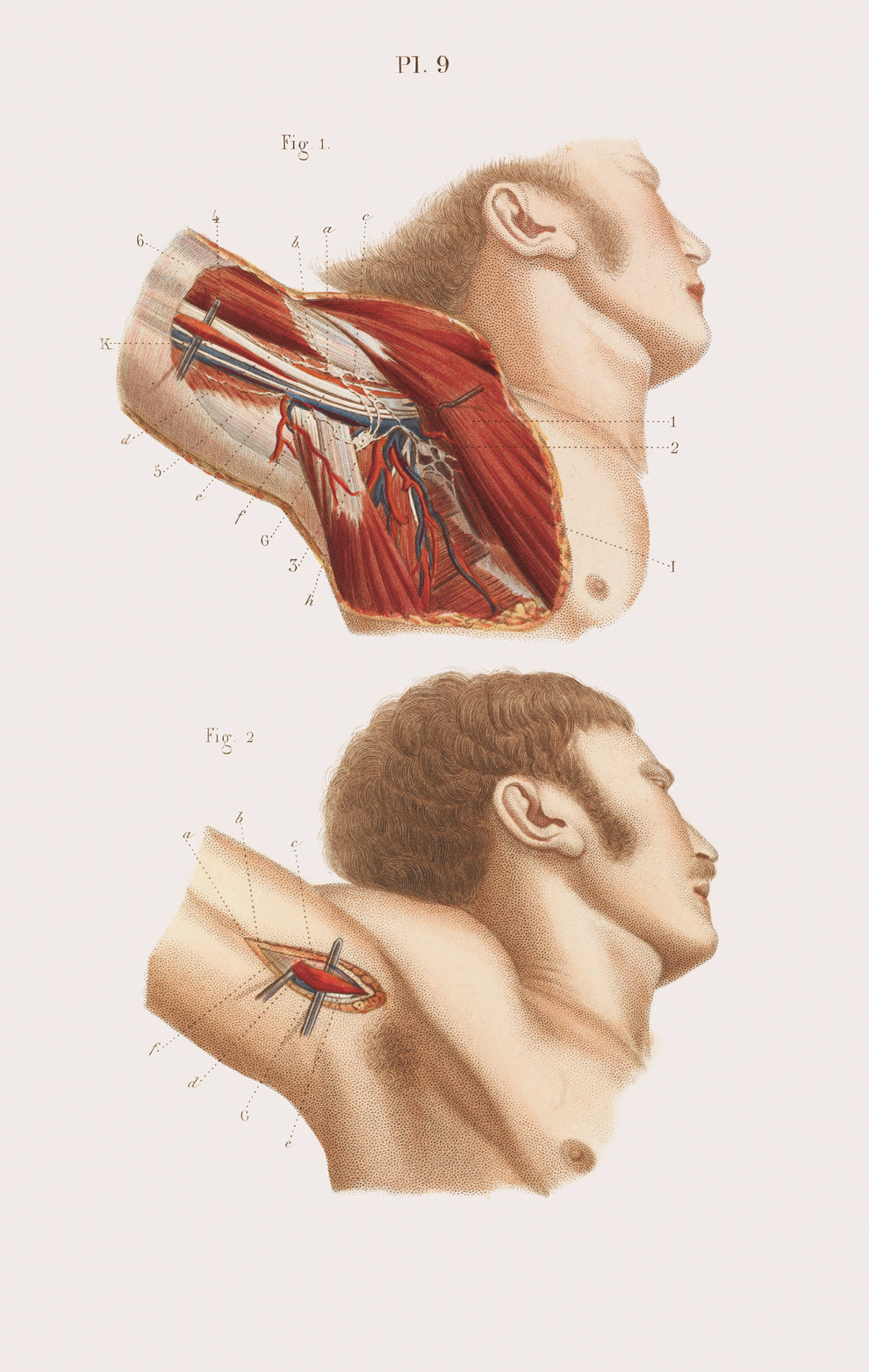 Anatomy of the armpit, and the ligature (clamping by string to stop the blood flow) of a blood vessel near it.