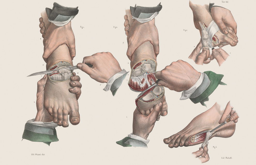 Amputation of various toes.