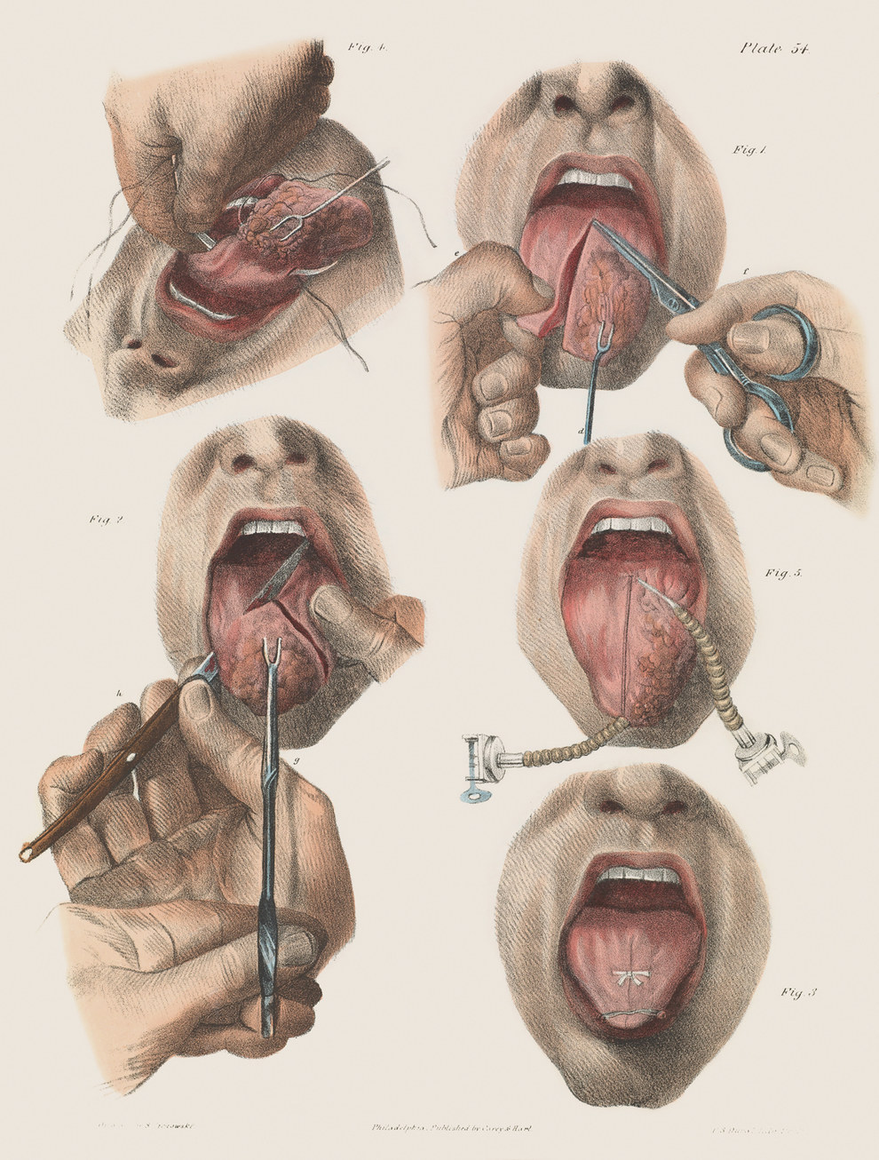 Surgery for cancer of the tongue.