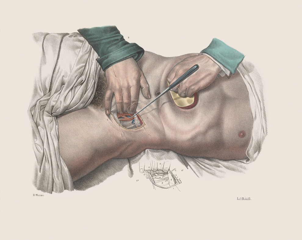 Ligature of an artery in the inguinal region, using sutures and a suture hook, with compression of the abdomen to reduce aortic blood flow.