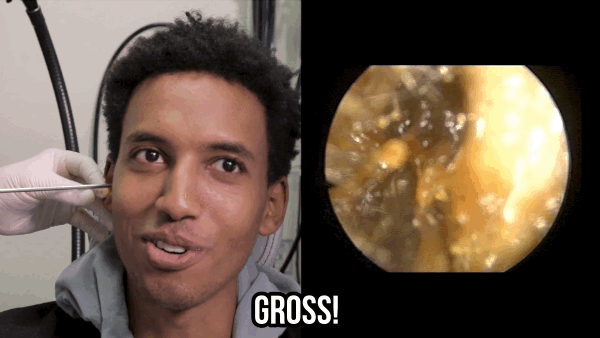 These People Got Their Ears Extracted For The First Time And It Was Grossly Hilarious