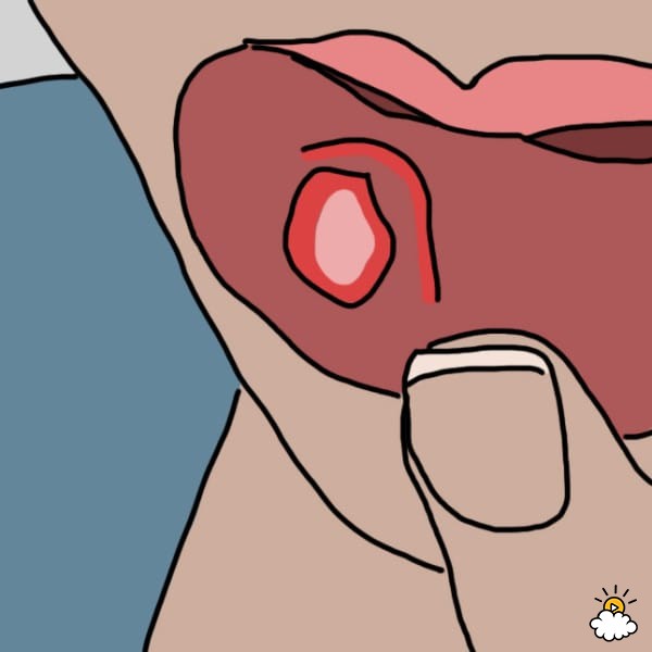 What Is a Canker Sore?