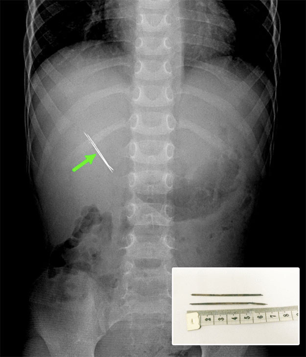 This 4-year-old boy who'd managed to get a 2-inch pin stuck through his kidney.