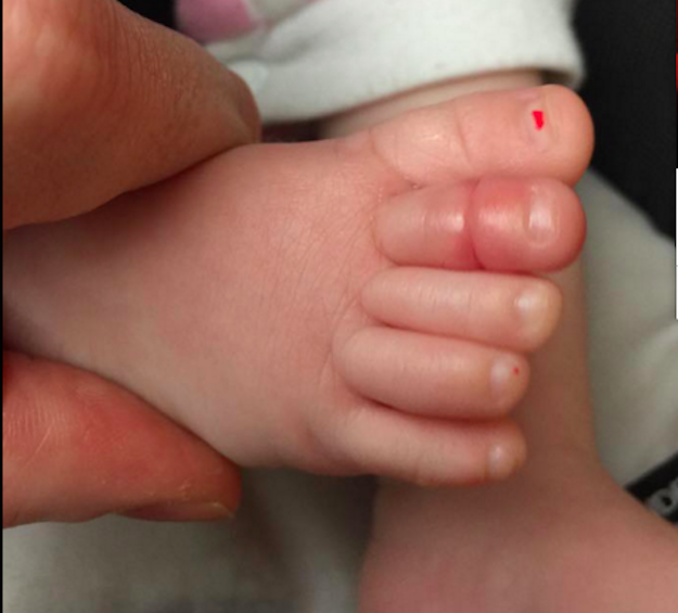 Walker's wife noticed Molly seemed to be overheating, so she took off the baby's socks. Then, she noticed something strange on her baby's toe.