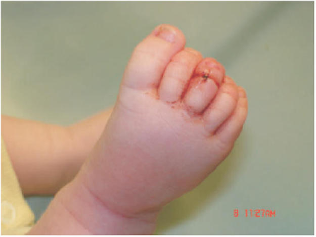 The baby had wrapped a piece of hair around her toe so tightly, it had cut into her skin. Doctors call the phenomenon "toe-tourniquet syndrome" or a "hair tourniquet."