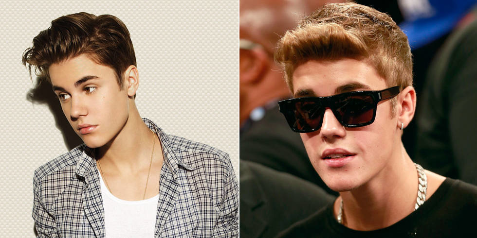 It's totally natural to have a little acne at this age Justin Bieber. 
