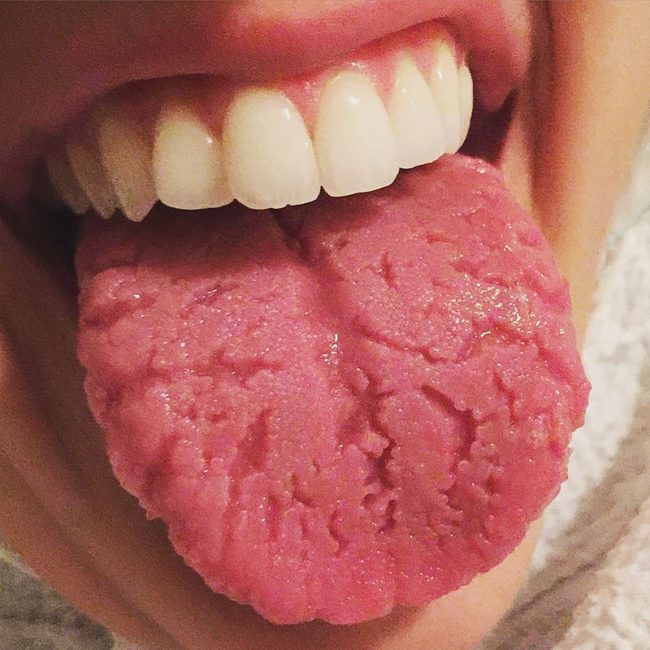 Fissured tongue.