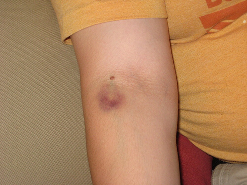banana-peel-uses-heals-bruise