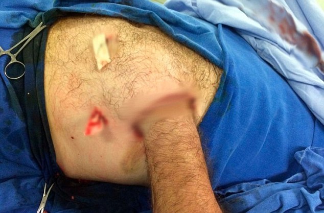 Doctors decided to bury Carlos Mariotti's left hand inside his abdomen and cover it with a flap of protective skin after the machine production operator suffered a horrific work accident that ripped off all the skin on his hand