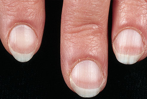 liver-disease-nails