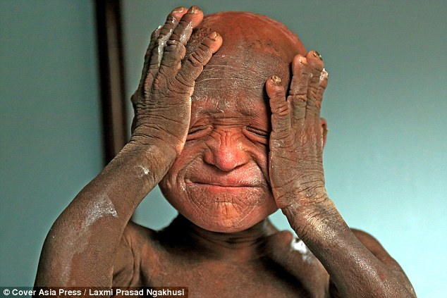 Constant pain: Ramesh Darji suffers from Ichthyosis, an extremely rare condition which causes his skin to grow quickly and thickly - giving the appearance of having scales, or turning into stone