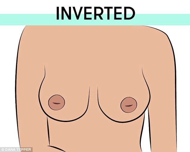 Inverted nipples are tucked away inside the skin and not visible