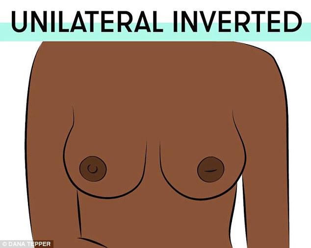 A unilateral inverted in when one nipple is raised but another one is inverted and tucked away