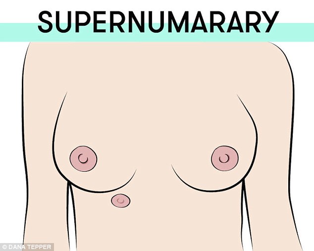 Supernumery nipples are extra smaller nipples. They can either look like flat moles or raised bumps
